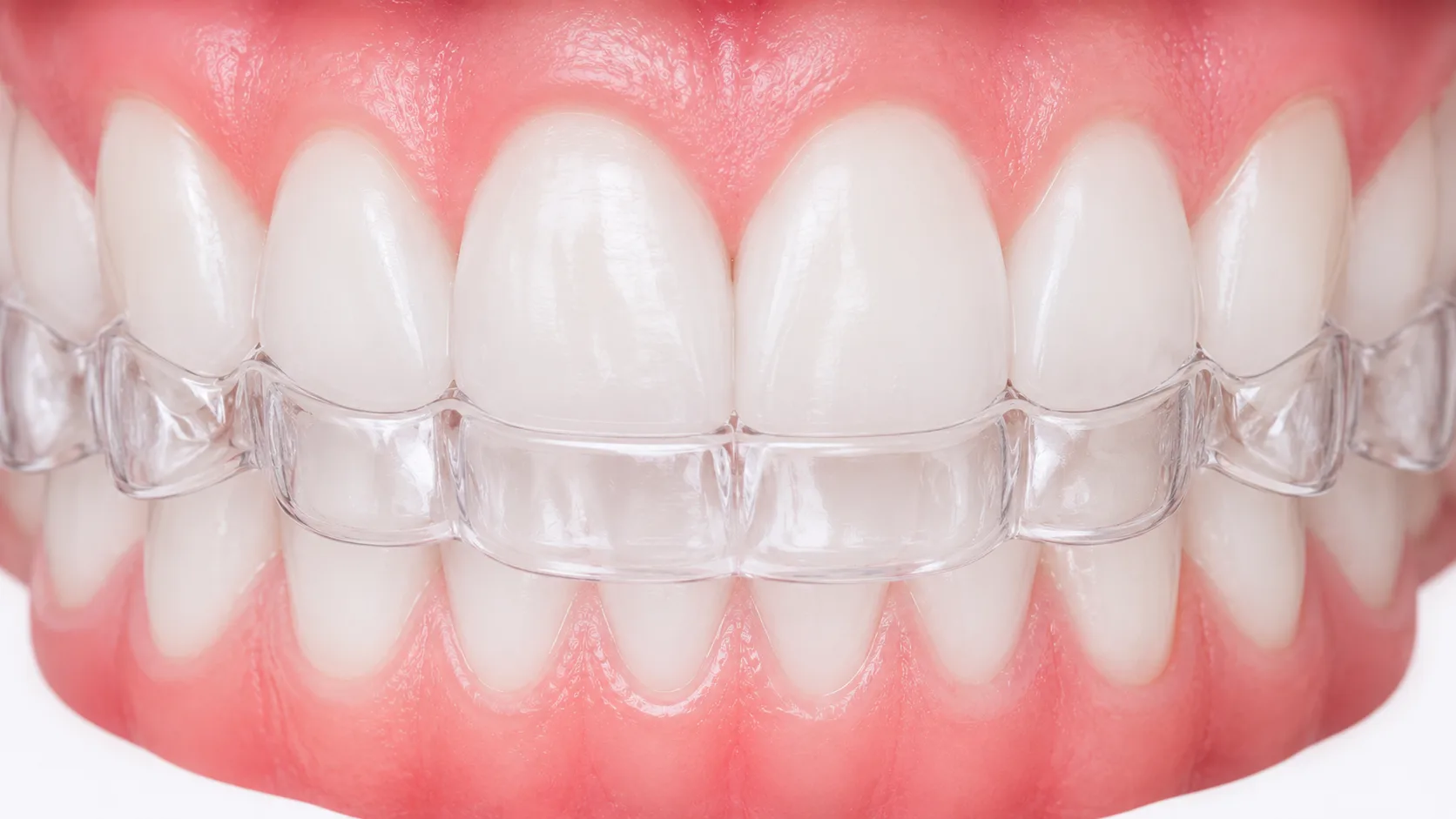 Comparação da saúde gengival entre pacientes com Invisalign e aparelho fixo