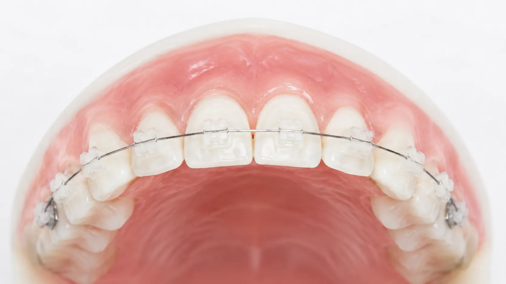 Aparelho fixo cerâmico estético com brackets de zircônia nos dentes