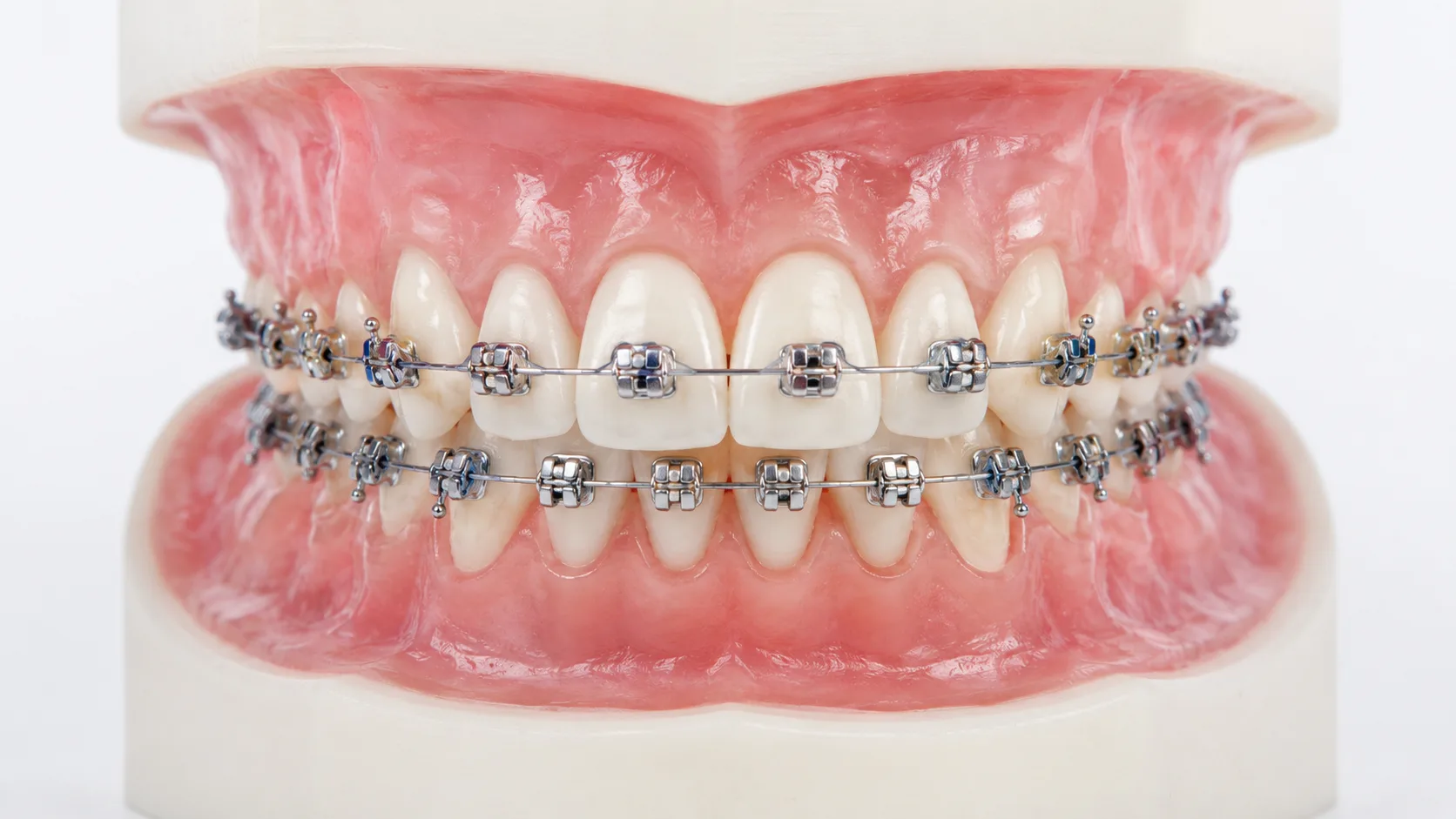 Aparelho autoligado com slide metálico fechado nos brackets